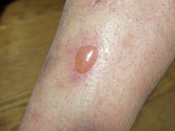 やけど虫に触れてはいけない 生態と見かけたときの対処法 ミツモア やけど虫に触れてはいけない 生態と見かけたときの対処法 ミツモア