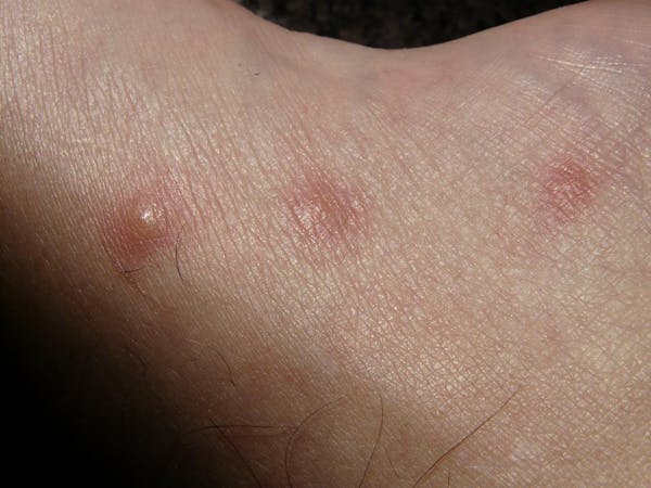 これってダニ刺され 症状の特徴と見分け方 あせも 蚊との違いは ミツモア これってダニ刺され 症状の特徴と見分け方 あせも 蚊との違いは ミツモア