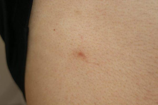 ノミに刺されたらどうすればいい 対処法や予防法をチェック ミツモア ノミに刺されたらどうすればいい 対処法や予防法をチェック ミツモア