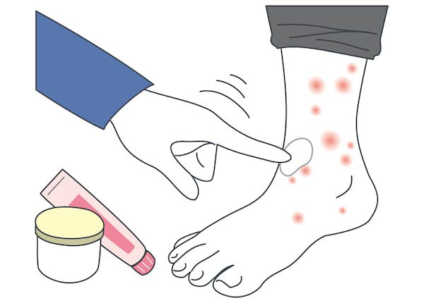 足の炎症に薬剤を塗る