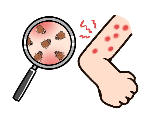 これってダニ刺され 症状の特徴と見分け方 あせも 蚊との違いは ミツモア これってダニ刺され 症状の特徴と見分け方 あせも 蚊との違いは ミツモア