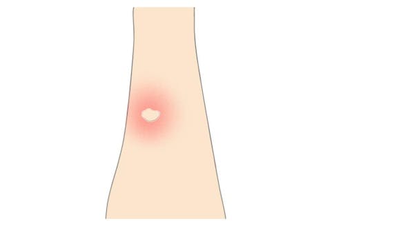 これってダニ刺され 症状の特徴と見分け方 あせも 蚊との違いは ミツモア これってダニ刺され 症状の特徴と見分け方 あせも 蚊との違いは ミツモア