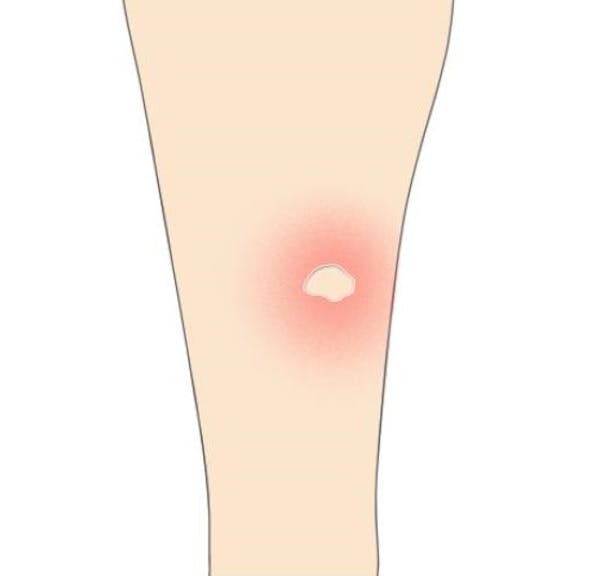ノミに刺されたらどうすればいい 対処法や予防法をチェック ミツモア ノミに刺されたらどうすればいい 対処法や予防法をチェック ミツモア