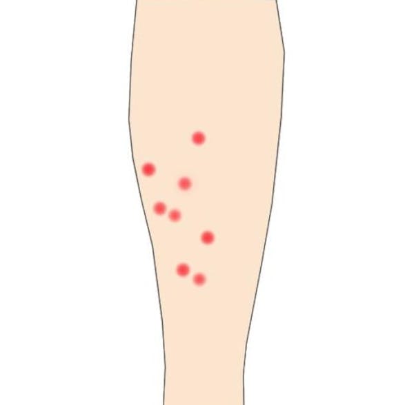 ノミに刺されたらどうすればいい 対処法や予防法をチェック ミツモア ノミに刺されたらどうすればいい 対処法や予防法をチェック ミツモア