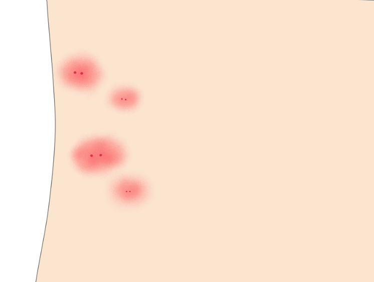 ダニ刺されの特徴と見分け方は？あせも・蚊との違いや治療法、ダニの駆除方法も解説